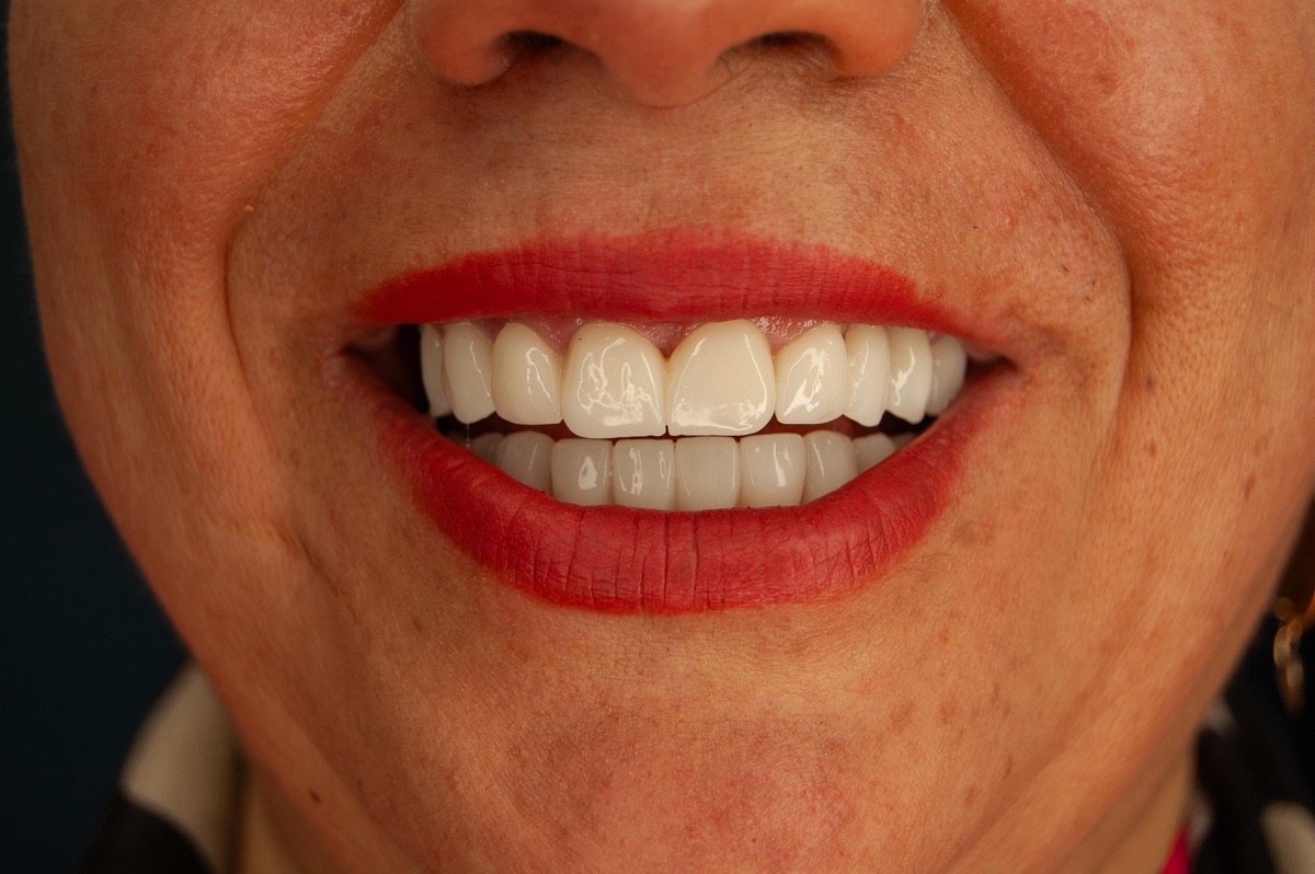 Hollywood smile tooth whitening